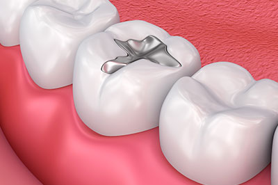 The image displays a close-up view of a human dental implant with a visible screw component, set within an artificial tooth structure against the backdrop of a partial denture framework.