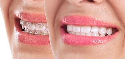 The image displays a close-up of a person s smiling face with teeth visible, showing the upper lip partially pulled back to reveal teeth, set against a white background.