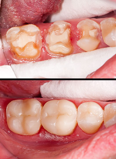 The image shows a close-up of an open mouth with visible teeth and gums, highlighting dental issues such as decay and discoloration, with two panels showing the same oral condition before and after treatment.