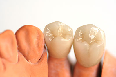 The image shows a pair of human teeth with visible enamel surfaces, set against a light background, possibly for dental educational purposes.