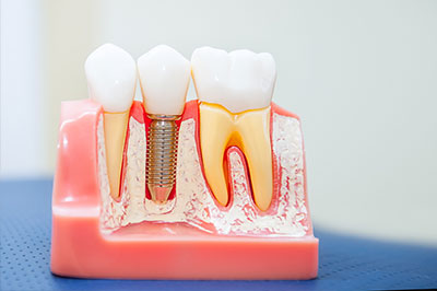 The image shows a clear plastic dental model with multiple teeth, some with fillings and others showing signs of decay or damage, placed on a blue surface with a focus on oral health care practices.