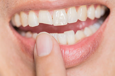 The image shows a close-up view of a person s mouth with teeth, holding their finger near their upper lip, which appears to be missing a tooth.