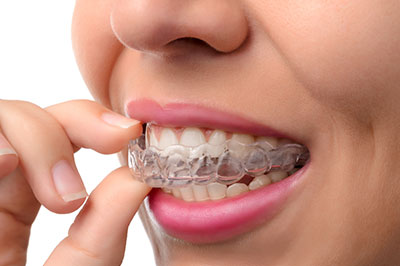 The image shows a woman with a wide smile, wearing a clear braces system, holding her finger near her mouth, possibly adjusting her teeth alignment.