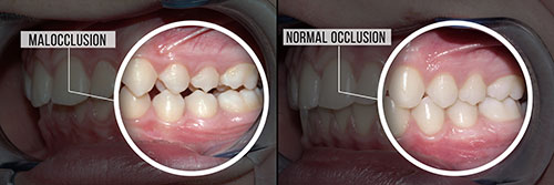 The image shows two side-by-side photographs of a person s teeth with annotations indicating  Malocclusion  on one side and  Normal occlusion  on the other, highlighting the difference between misaligned teeth and properly aligned ones.