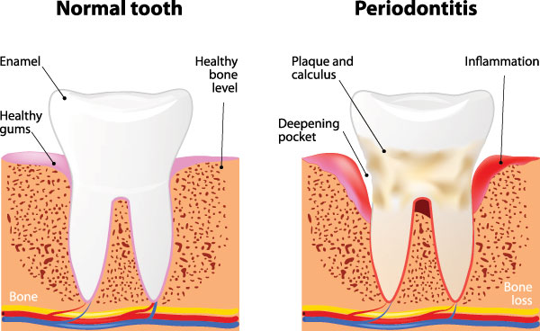 The image displays a diagrammatic representation of tooth decay progression from normal to advanced stages, including a healthy tooth on the left, an enamel-damaged tooth in the middle, and a severely decayed tooth on the right, with labels indicating different stages of decay and accompanying text explaining the process.