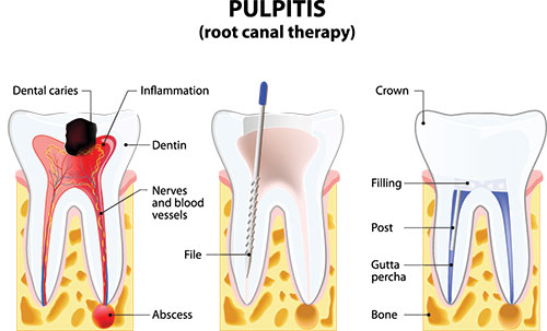 The image presents a detailed illustration of a dental pulpitis, showing various stages from initial inflammation to advanced infection, with labels indicating the affected areas and structures.