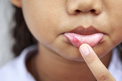 A young girl with a noticeable red mark on her chin.