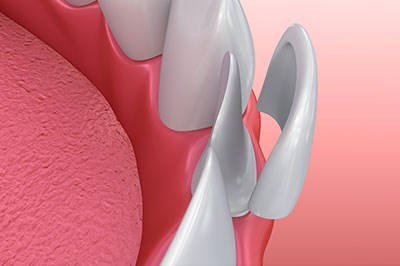 The image shows a close-up view of a dental implant with a screw visible on its surface, set within a human mouth against a pink background that suggests gum tissue.