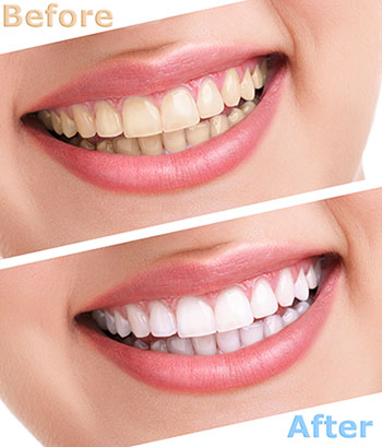 Before and after teeth whitening advertisement showcasing a bright smile transformation.